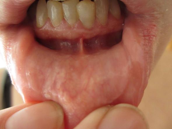 Mundschleimhaut verändert > Krebs (Tumor)